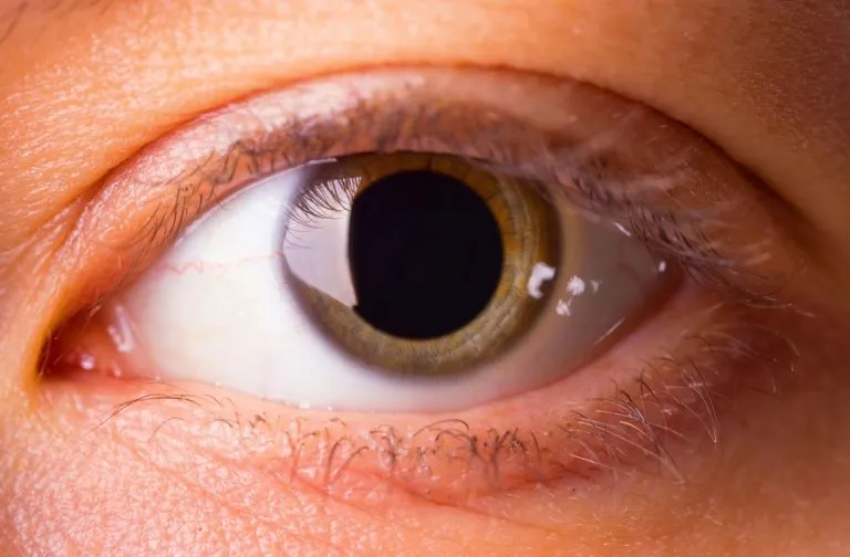 Por que dilatar a pupila no oftalmologista